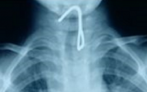 nghe an cam moc sat choi roi nuot vao mieng be trai 26 thang tuoi thung thuc quan