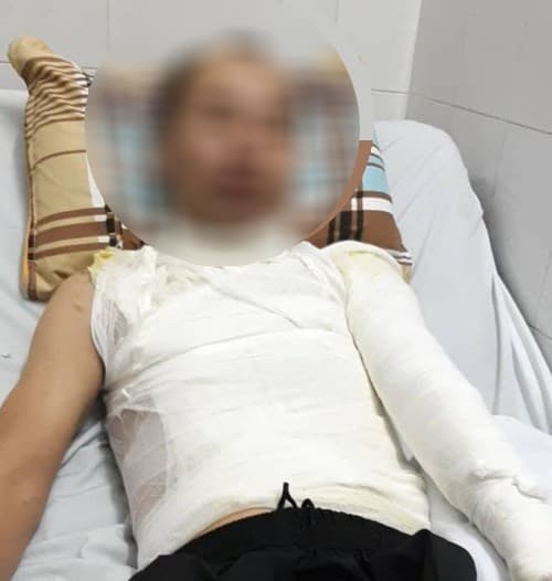 ha noi dieu tra mot nguoi dan ong bi tat ca ca a xit vao mat