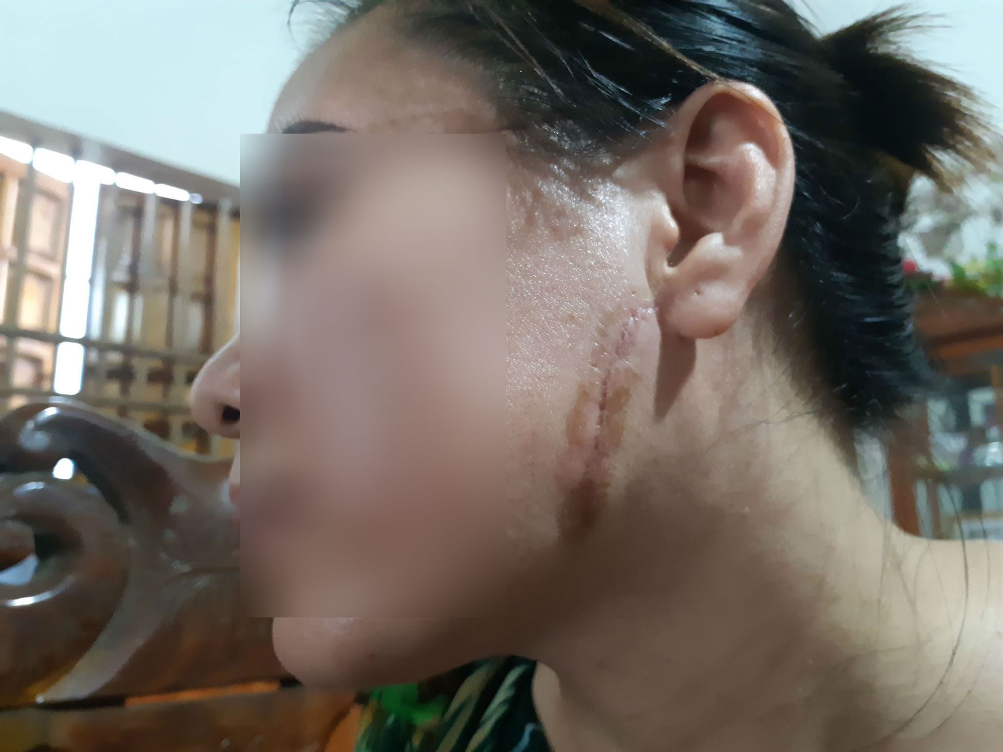 qua 3 lan do nguoi phu nu bac giang van khong tranh khoi kiep gian truan bi chong rach mat cat gan chan vi cuong ghen