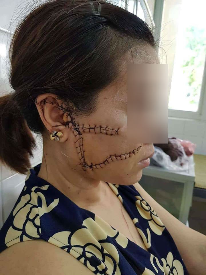 qua 3 lan do nguoi phu nu bac giang van khong tranh khoi kiep gian truan bi chong rach mat cat gan chan vi cuong ghen