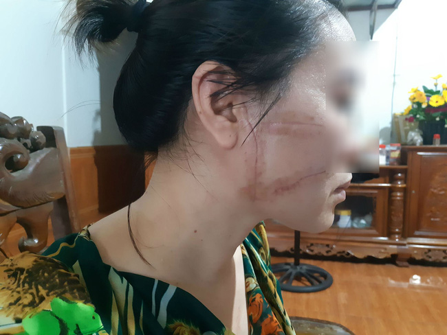 qua 3 lan do nguoi phu nu bac giang van khong tranh khoi kiep gian truan bi chong rach mat cat gan chan vi cuong ghen