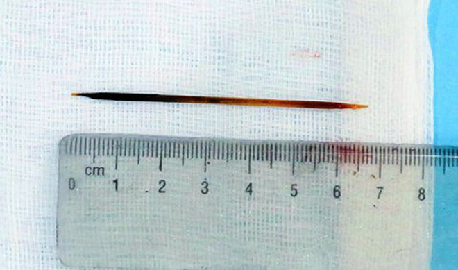 nguoi dan ong o nghe an nuot phai tam dai 7cm vi ngu quen