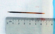 nguoi dan ong o nghe an nuot phai tam dai 7cm vi ngu quen