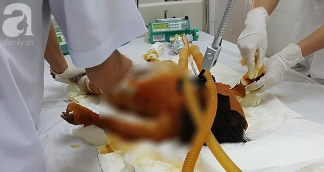 soc trang bo me vang nha 3 chi em choi dot rac khien be gai 20 thang tuoi bong nang den 90