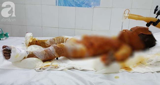 soc trang bo me vang nha 3 chi em choi dot rac khien be gai 20 thang tuoi bong nang den 90