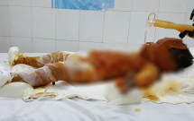 soc trang bo me vang nha 3 chi em choi dot rac khien be gai 20 thang tuoi bong nang den 90