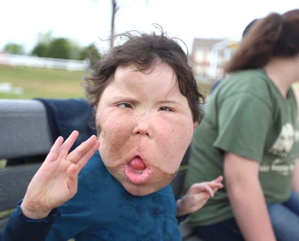 be gai 9 tuoi mac chung benh la lung khong ten trai qua vo so cuoc phau thuat