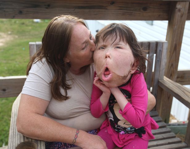 be gai 9 tuoi mac chung benh la lung khong ten trai qua vo so cuoc phau thuat