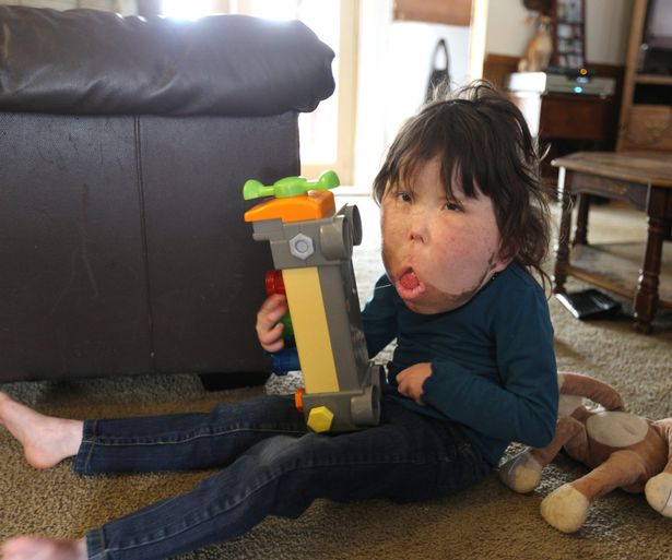 be gai 9 tuoi mac chung benh la lung khong ten trai qua vo so cuoc phau thuat