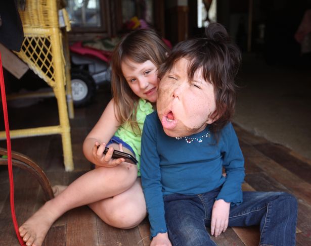 be gai 9 tuoi mac chung benh la lung khong ten trai qua vo so cuoc phau thuat