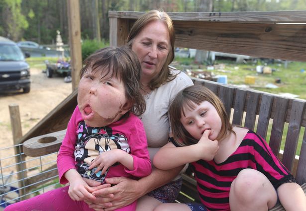 be gai 9 tuoi mac chung benh la lung khong ten trai qua vo so cuoc phau thuat