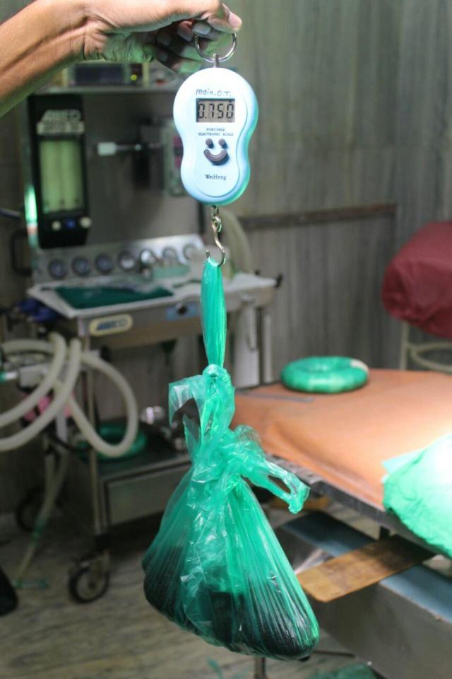 nhung soi toc ben chat thanh bui lon trong da day va ruot non cua co gai tre co so thich an toc
