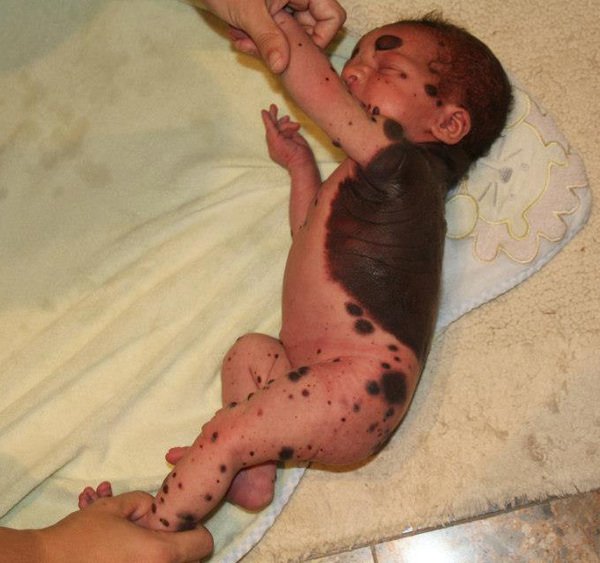 me dau don khi nhin thay 80 co the cua con so sinh phu day vet bot vay nhung do van chua phai la dieu toi te nhat