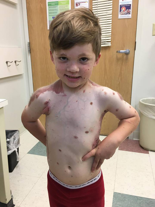 me dau don khi nhin thay 80 co the cua con so sinh phu day vet bot vay nhung do van chua phai la dieu toi te nhat