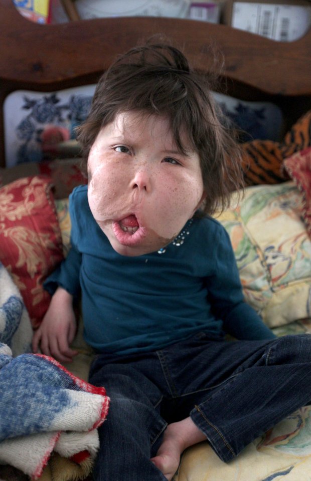 mac benh hiem ca bac si cung chua dat ten be gai 9 tuoi mang guong mat khong lo bien dang