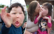 mac benh hiem ca bac si cung chua dat ten be gai 9 tuoi mang guong mat khong lo bien dang