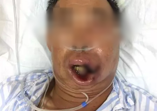 nguoi dan ong suyt tu vong vi tu y nan mun to o moi