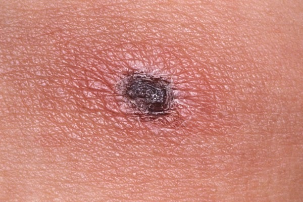 benh sot mo de gay tu vong neu khong phat hien kip thoi