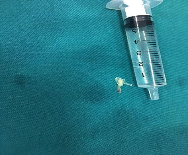 be trai 10 thang tuoi o nghe an hoc xuong ca gan 1 cm