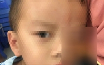 vap nga khi chay phu cha day xe be trai 4 tuoi bi xien ca vien dam sau vao hoc mat