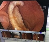 nghe an nam hoc sinh nghi phe co can dut tai ban roi nuot luon vao bung