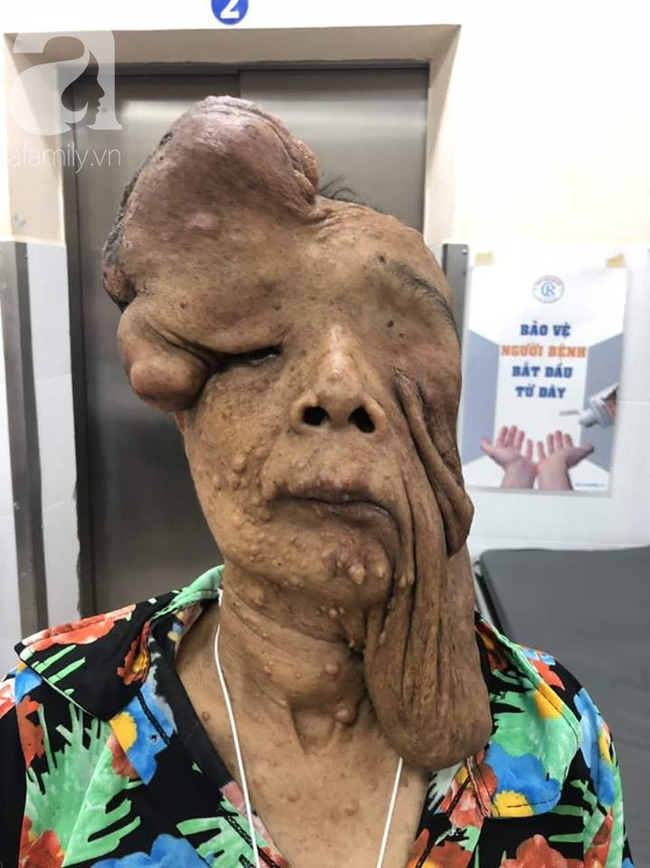 tphcm nu di nhan 10 nam khong dam ra duong vi guong mat vua chay vua noi cuc meo mo bien dang khung khiep