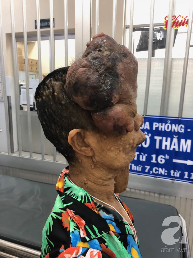 tphcm nu di nhan 10 nam khong dam ra duong vi guong mat vua chay vua noi cuc meo mo bien dang khung khiep