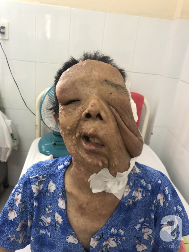 tphcm nu di nhan 10 nam khong dam ra duong vi guong mat vua chay vua noi cuc meo mo bien dang khung khiep