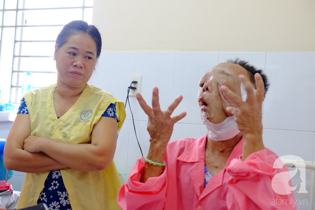 tphcm nu di nhan 10 nam khong dam ra duong vi guong mat vua chay vua noi cuc meo mo bien dang khung khiep