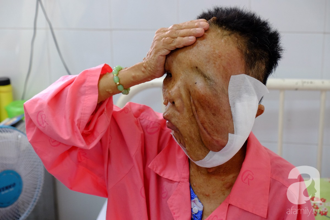 tphcm nu di nhan 10 nam khong dam ra duong vi guong mat vua chay vua noi cuc meo mo bien dang khung khiep