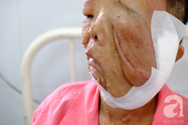 tphcm nu di nhan 10 nam khong dam ra duong vi guong mat vua chay vua noi cuc meo mo bien dang khung khiep