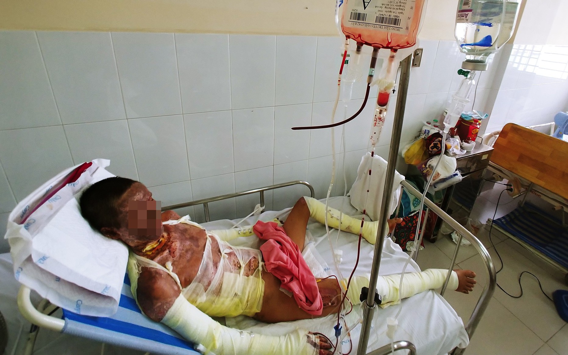 Hơn 200 triệu đồng trợ giúp người vợ Cà Mau nuôi chồng bỏng nặng vì cháy nhà nhưng nạn nhân đã mất