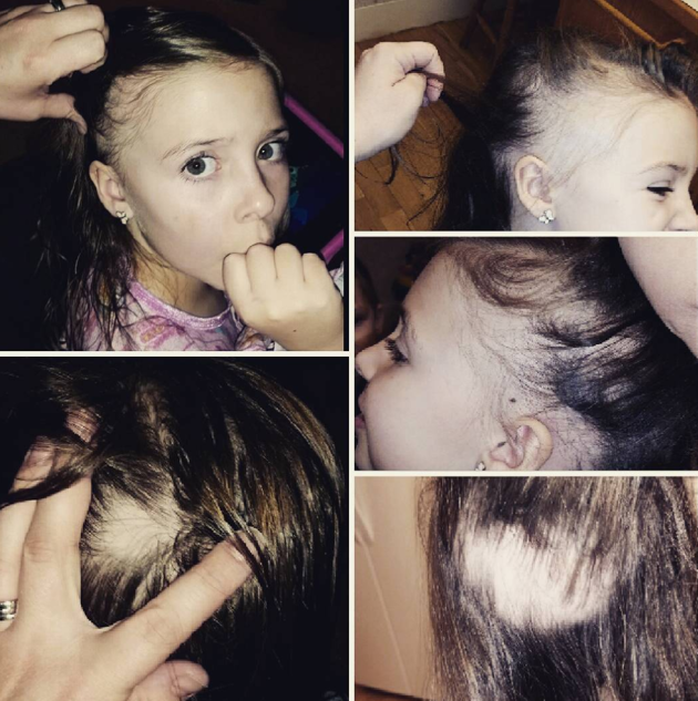 toc con vuong day luoc khi chai me nghi ngo can benh nay va day la chan doan chinh xac cua bac si