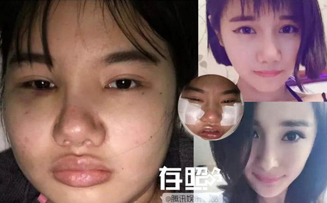 thoi buoi bay gio da ham mo cuong nhiet la phai phau thuat tham my cho xinh dep giong than tuong co