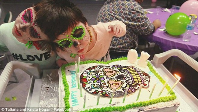 11 nam thang tram cua cap song sinh dinh lien phan dau tung duoc bac si du doan chi song khong qua 1 ngay