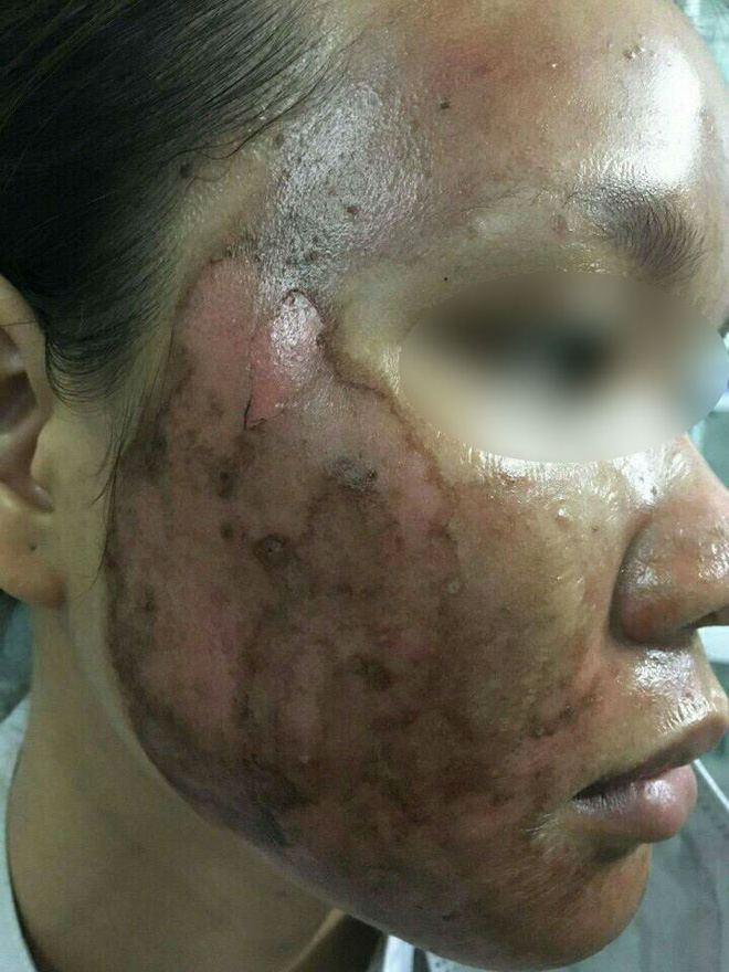 ky uc kinh hoang sau lan lam dep dai dot den bong rop ca mat cua co gai tre