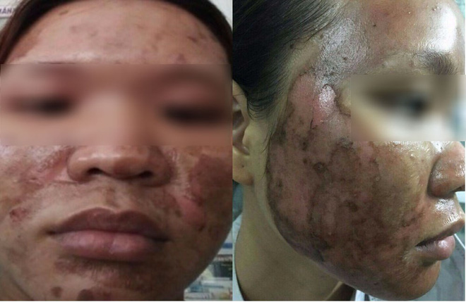 ky uc kinh hoang sau lan lam dep dai dot den bong rop ca mat cua co gai tre
