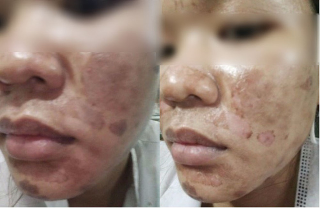 ky uc kinh hoang sau lan lam dep dai dot den bong rop ca mat cua co gai tre