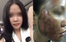 ky uc kinh hoang sau lan lam dep dai dot den bong rop ca mat cua co gai tre