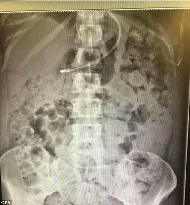 noi tang nguoi phu nu bi nhan chim trong chat thai den muc nghet tho chi vi mot so suat trong phau thuat