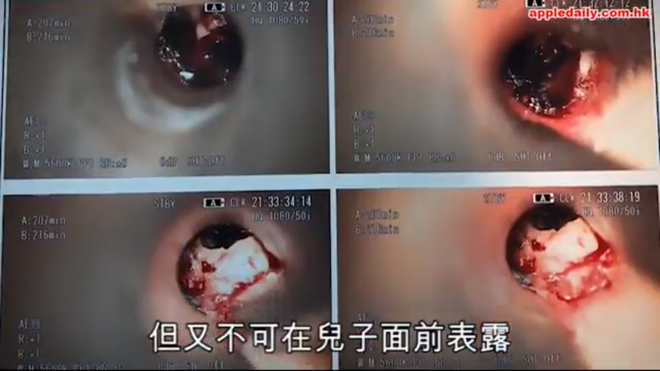 bi ban hoc bat nat nhet tay vao tai be trai so den noi hoang loan doi chet thinh giac bi anh huong nghiem trong