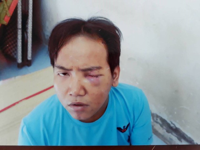 tung bi benh tam than phan liet bao ve dan pho sat hai be 6 tuoi o sai gon se bi xu ly the nao