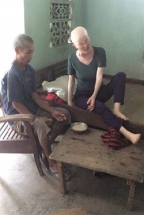 nghe an xot thuong gia canh chong tan tat cham vo ung thu con dinh ruot