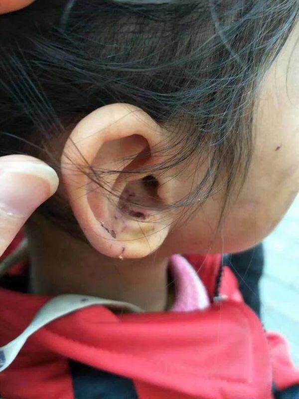 be gai 6 tuoi bi me de nguoc dai da man khien mat day vet thuong toc rung thanh mang lon