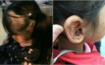 be gai 6 tuoi bi me de nguoc dai da man khien mat day vet thuong toc rung thanh mang lon