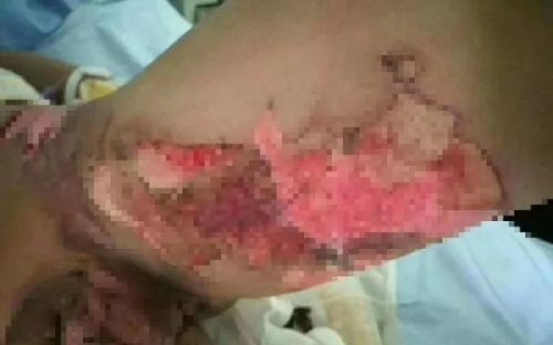 Kinh hoàng: Hai học sinh tiểu học bị bạn cùng lớp dội nước sôi vào người gây nhiễm trùng nghiêm trọng