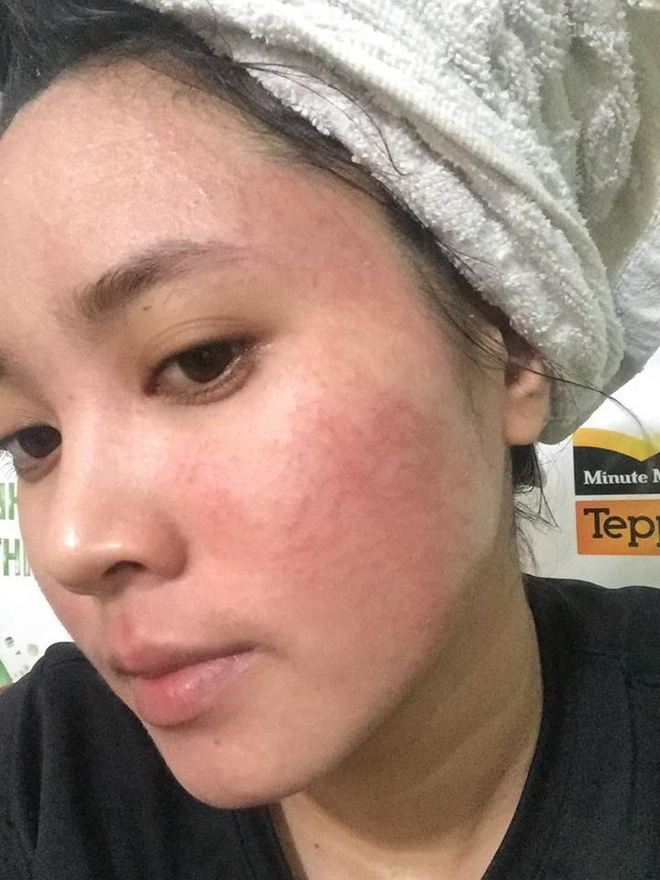 boi ruou thuoc bac de bong da tai tao co gai tre bi noi mun chi chit chay dich ngua khap mat