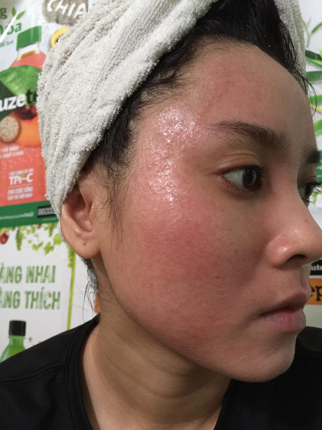 boi ruou thuoc bac de bong da tai tao co gai tre bi noi mun chi chit chay dich ngua khap mat