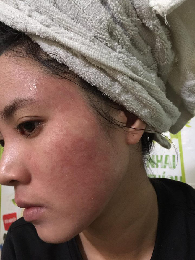 boi ruou thuoc bac de bong da tai tao co gai tre bi noi mun chi chit chay dich ngua khap mat