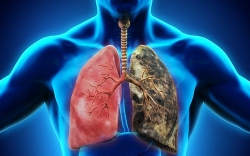 Ung thư phổi là gì? Nguyên nhân, triệu chứng và cách điều trị ung thư phổi